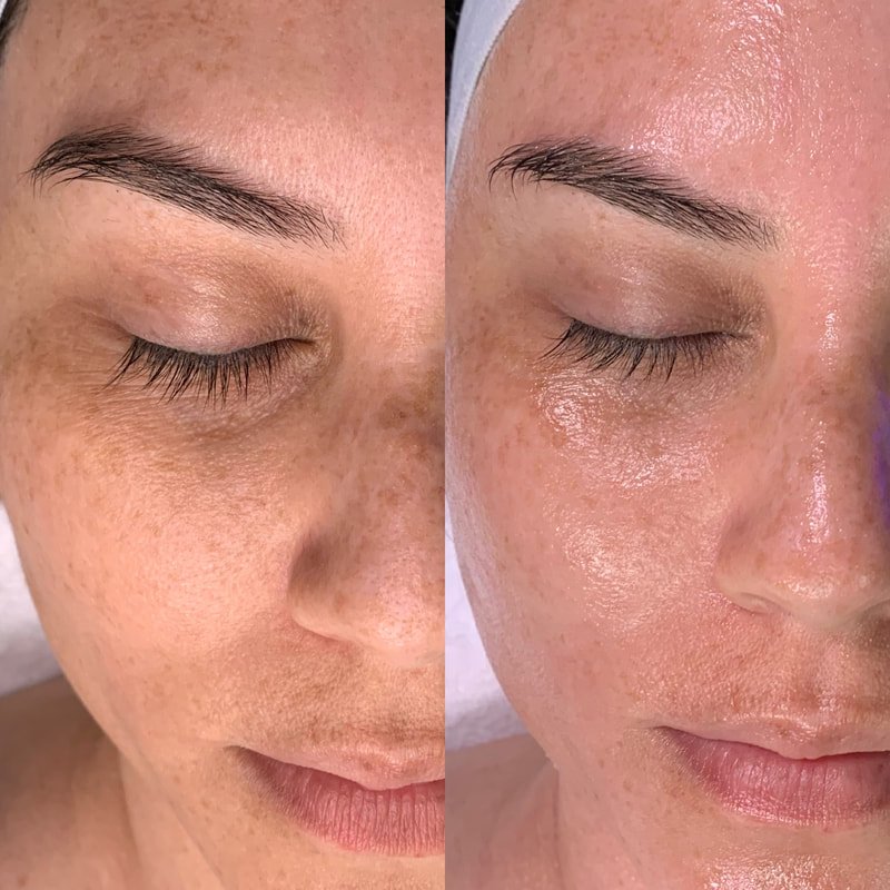 cheap hydrofacial