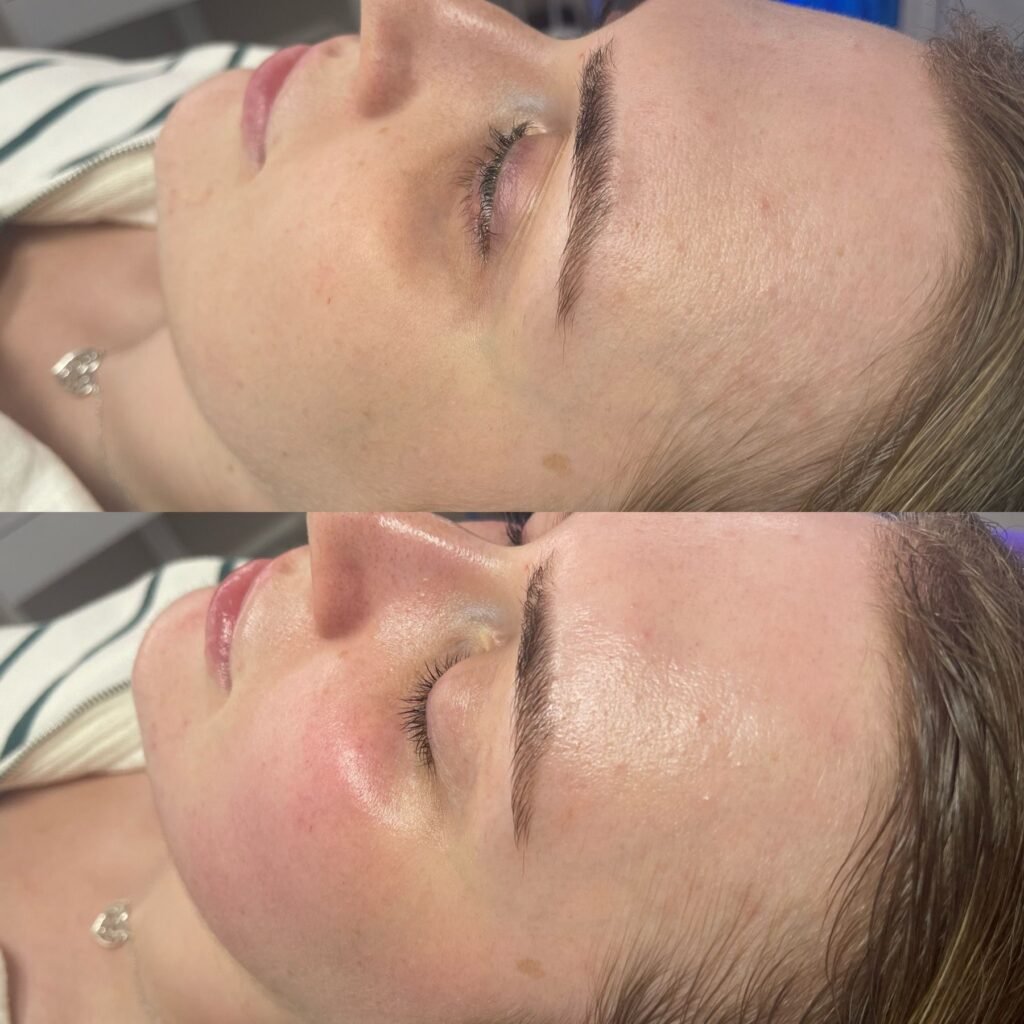 hydrofacial in calgary